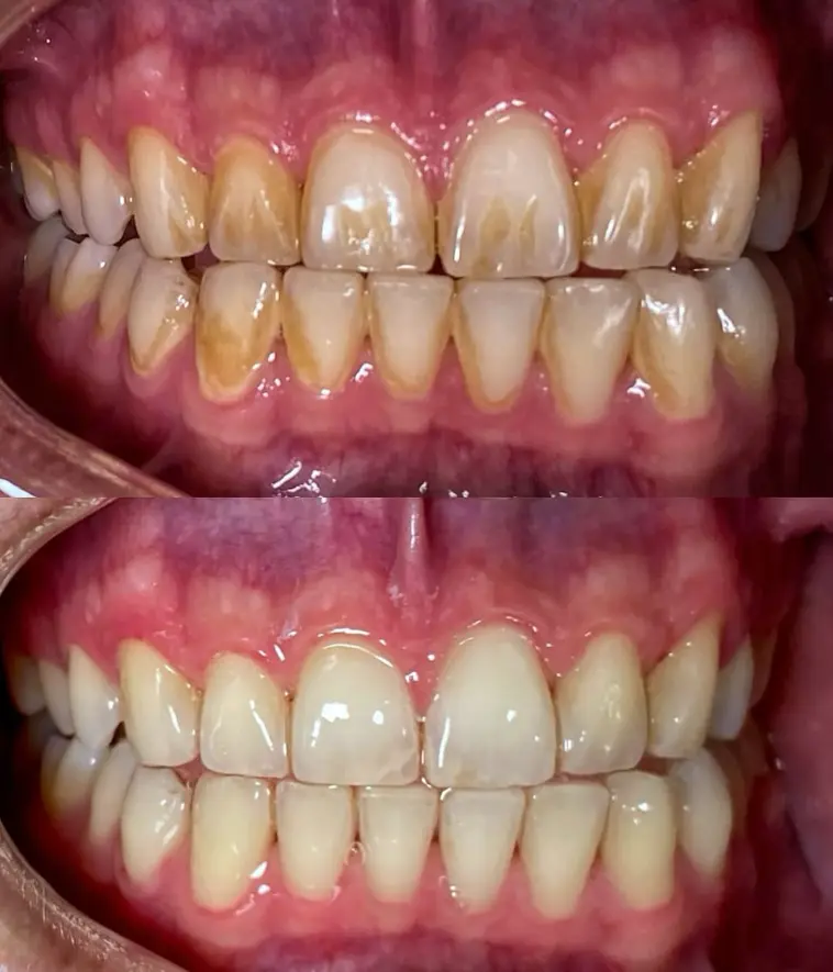 Caso clínico de restauração dentária