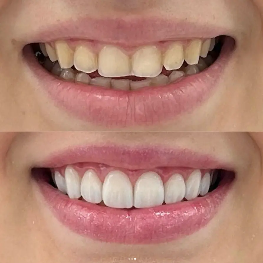 Procedimento de clareamento dental